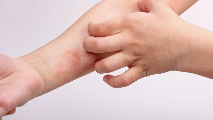 Eczema Dermatologist Appointments in Lusby Maryland